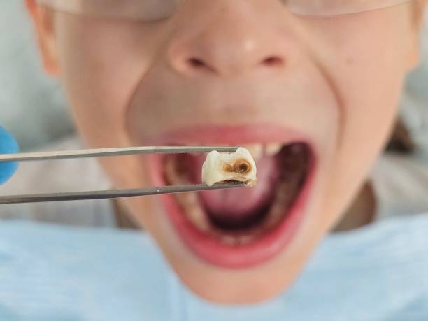 Best Emergency Tooth Extraction in Angier, NC